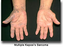 Multiple Kaposi's Sarcoma